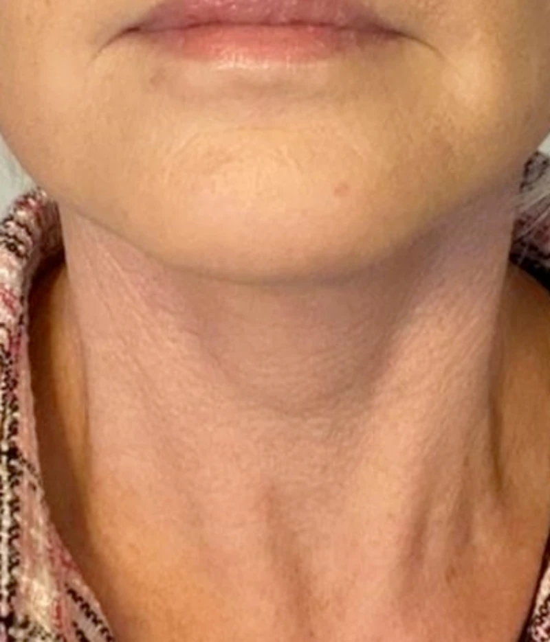 Neck Lift after
