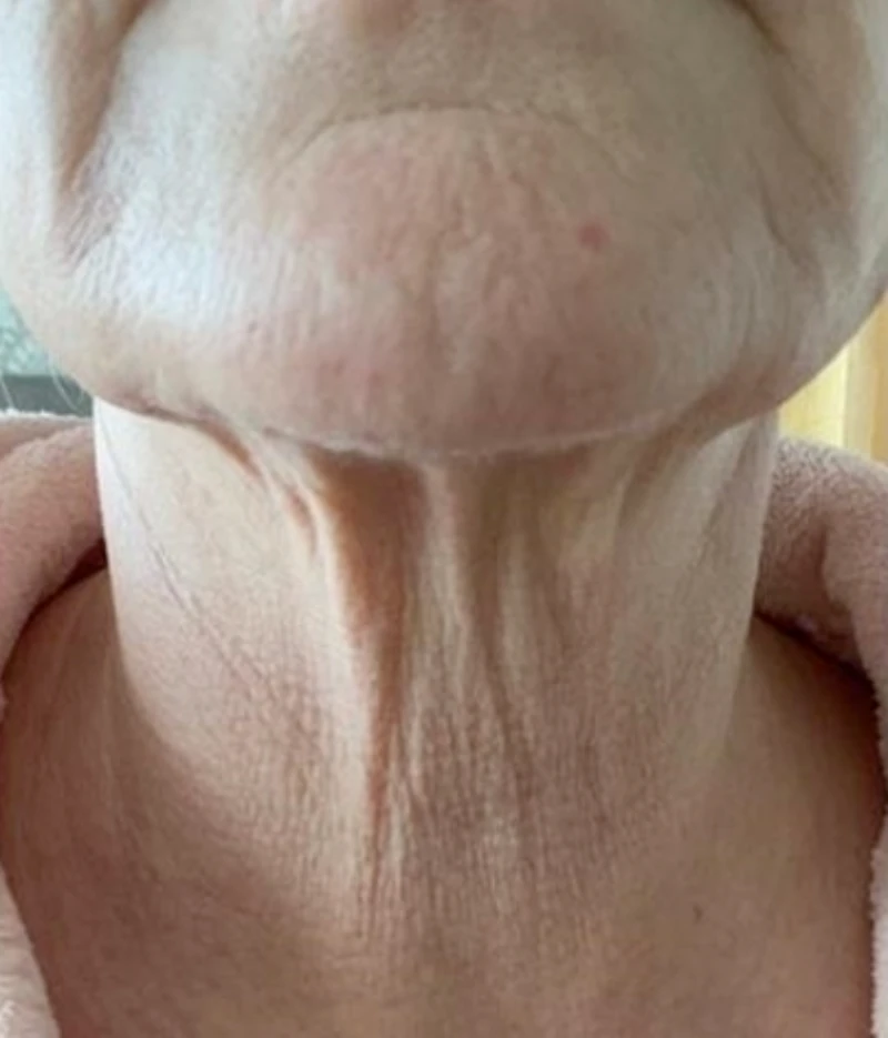 Neck Lift before