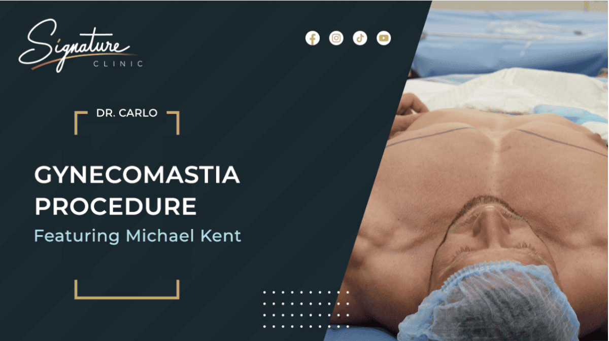 Unveiling Confidence: How UK Bodybuilding Champion Michael Kent Conquered Gynecomastia with Signature Clinic