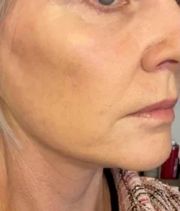 Signature Clinic facelift patient