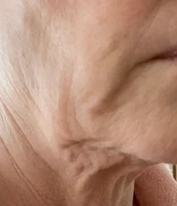 Signature Clinic facelift patient