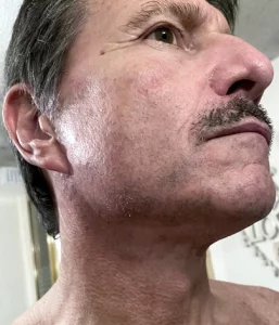 lower face lift results