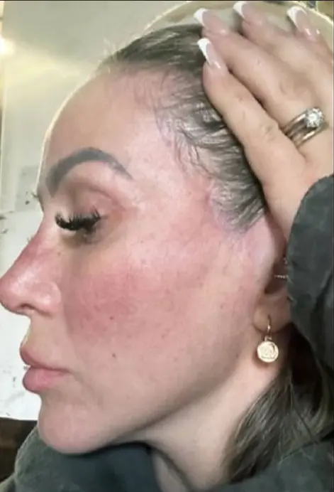 face lift