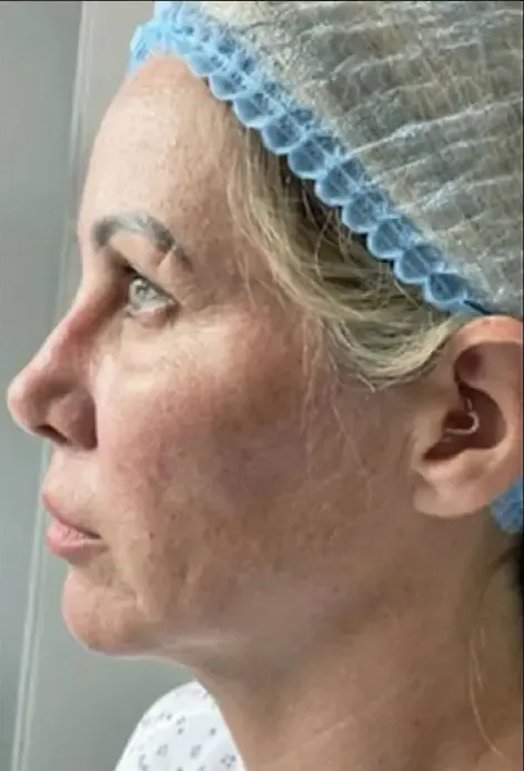 face lift before