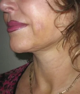 facelift before and after UK