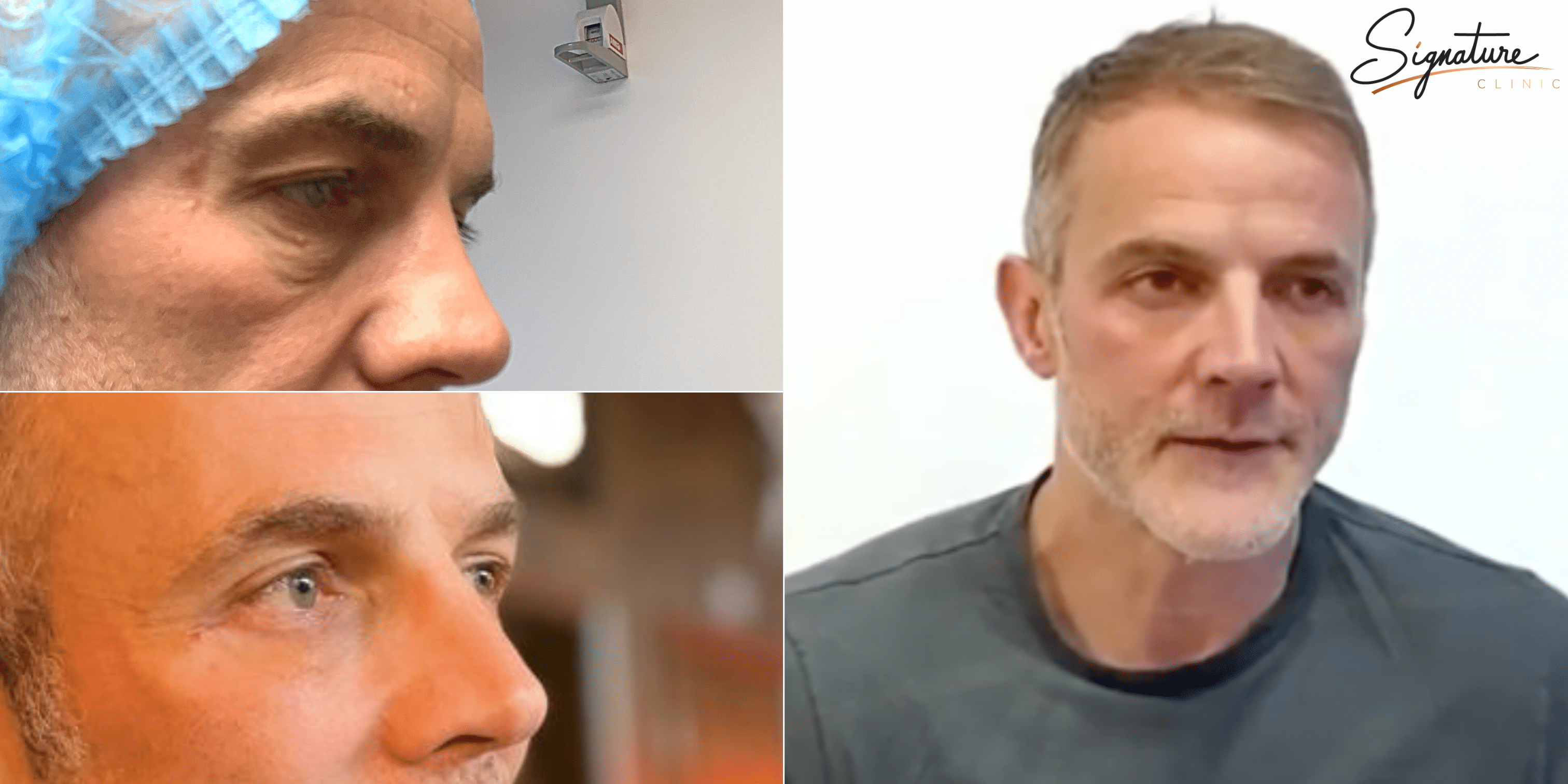Blepharoplasty surgery testimonial video at Signature Clinic