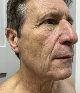 lower face lift results