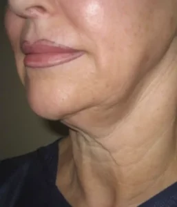 facelift before and after UK